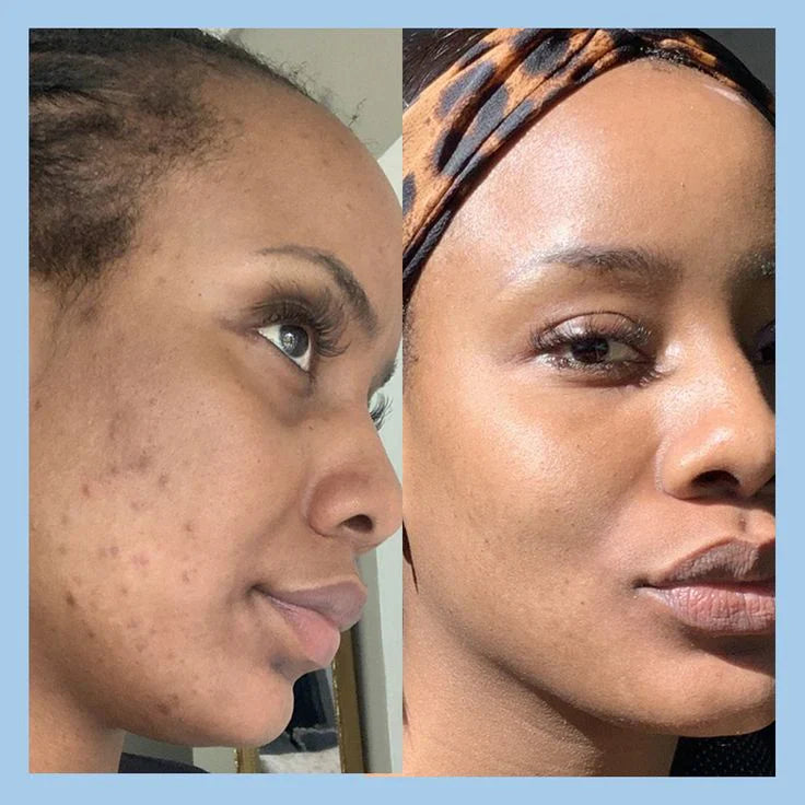 Yujia™ Melasma and Dark Spot Corrector Cream - YN