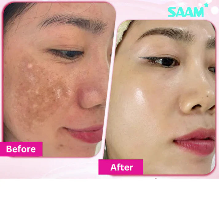 Yujia™ Melasma and Dark Spot Corrector Cream - YN