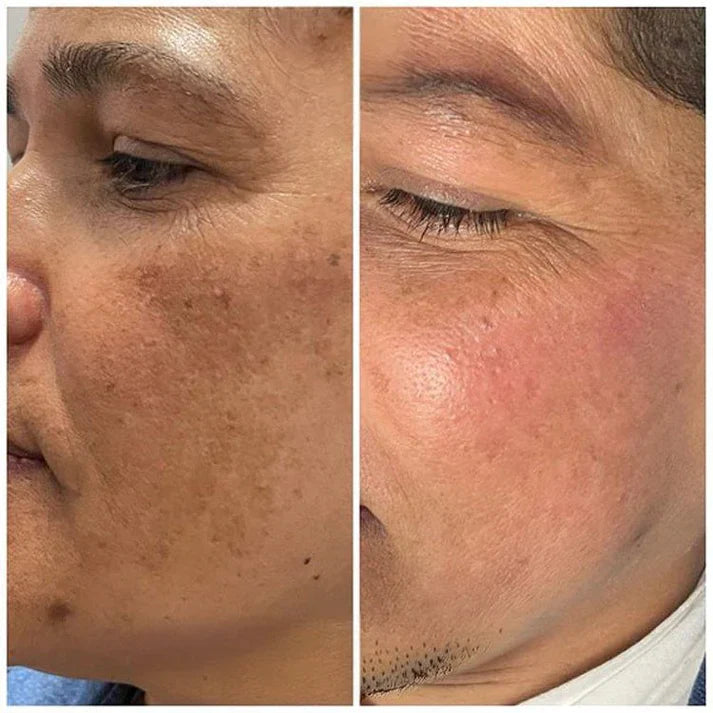 Yujia™ Melasma and Dark Spot Corrector Cream - YN
