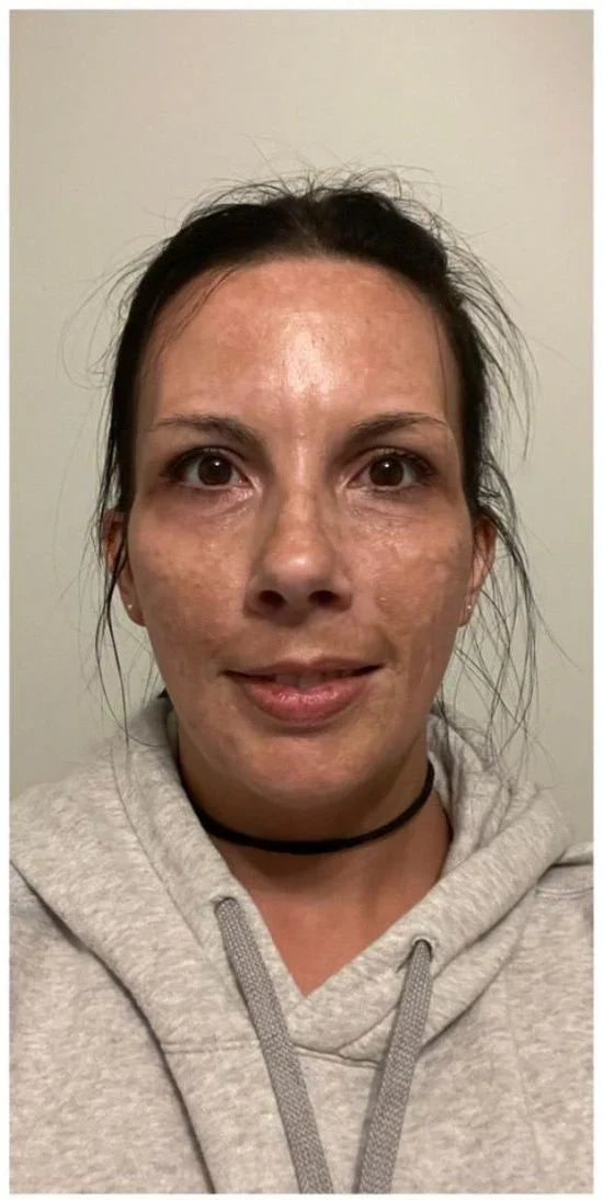 Yujia™ Melasma and Dark Spot Corrector Cream - YN