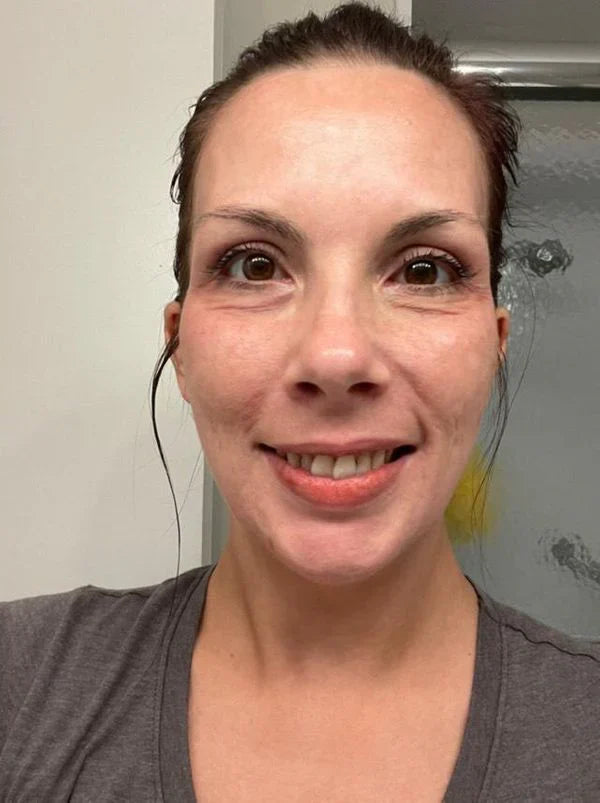 Yujia™ Melasma and Dark Spot Corrector Cream - YN